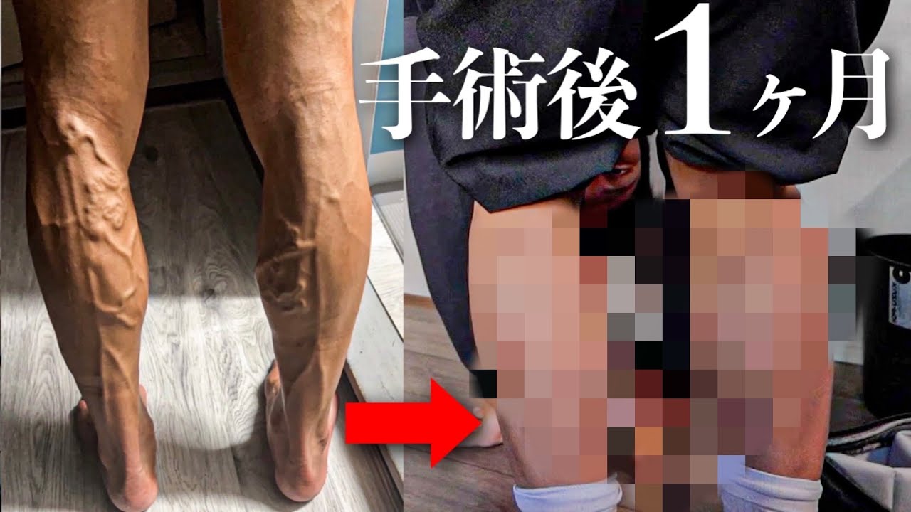 手術から1ヶ月。「全く違う脚」になりました。